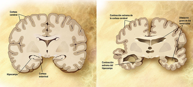 Archivo:Cerebro corte frontal Alzheimer.jpg
